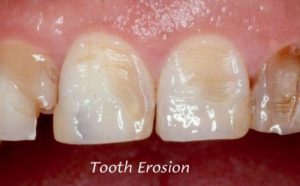 Paciente Bariatrico e o Impacto nos Dentes - Implante Laser