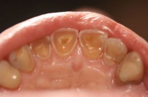 Paciente Bariatrico e o Impacto nos Dentes